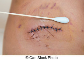 cicatriz.jpg cicatriz.jpg