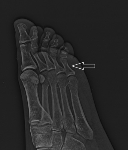 Raio X dedo do pé partido