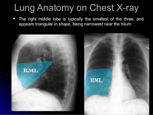 cxr-simple-by-drraghu-ram-6-638.jpg