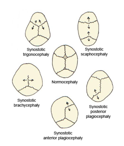 Single_suture_synostosis.png