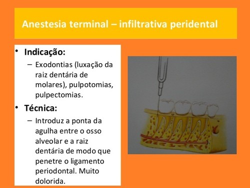 anestesia-local-em-medicina dentaria (7).jpg