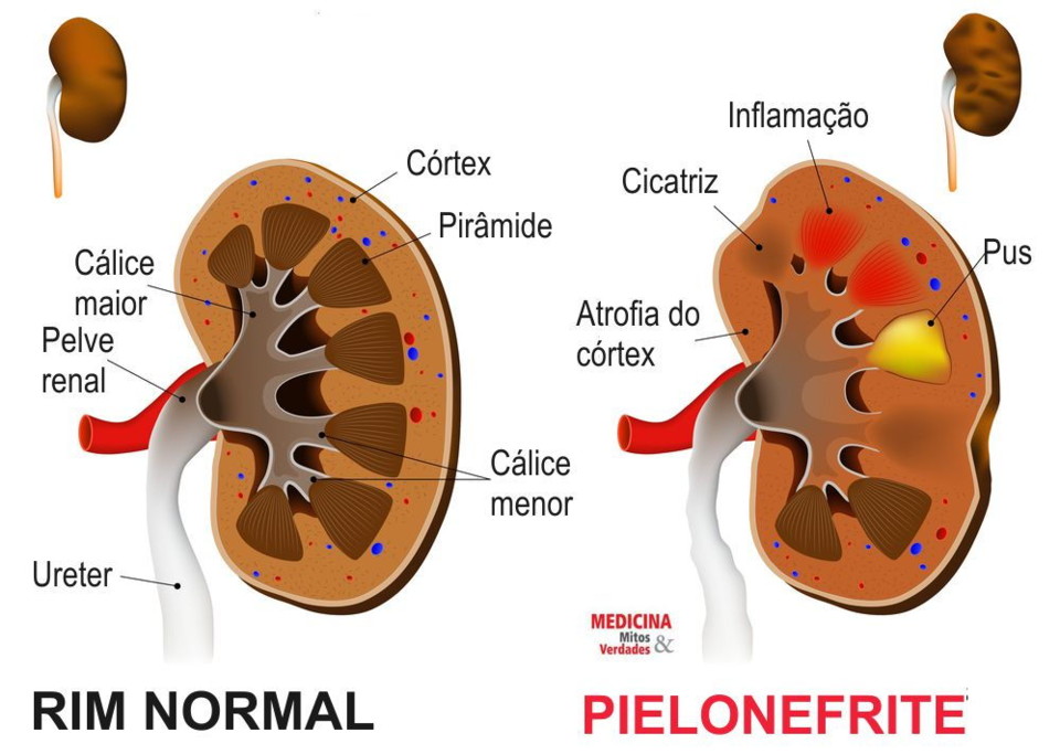401-pielonefrite-e-bacterias-no-rim.jpg