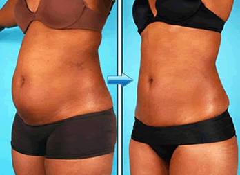 gordura-barriga.png gordura-barriga.png