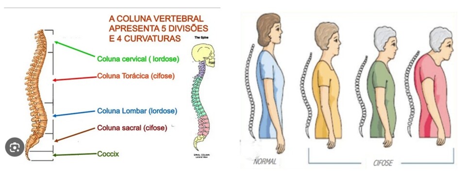 Cifose vertebral.jpg