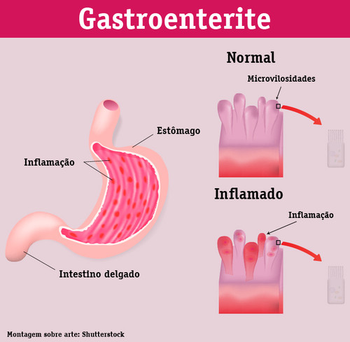 info-gastroenterite-viral.jpg