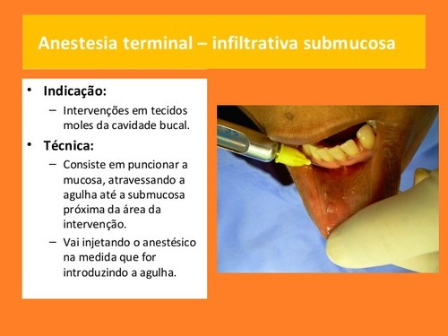 anestesia-local-em-medicina dentaria (3).jpg