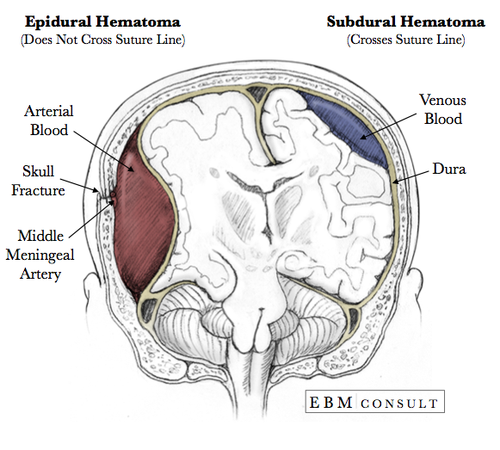 Subdural_Epidural_Hematoma_Image_v2 (2).png