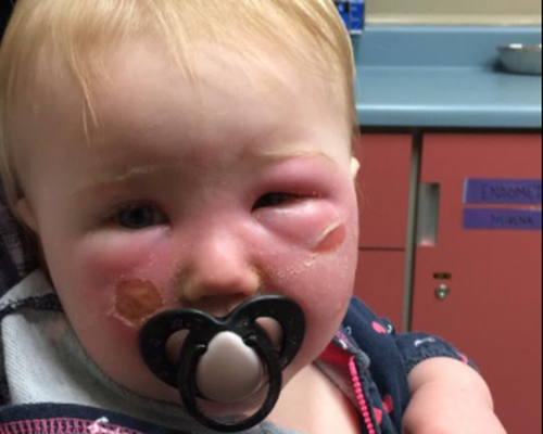 queimaduras.png queimaduras.png