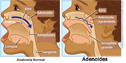 04. adenoides, polipos.jpg