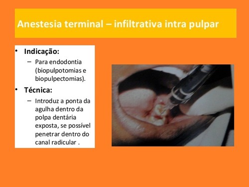 anestesia-local-em-medicina dentaria (8).jpg