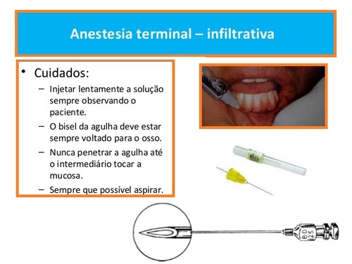 anestesia-local-em-medicina dentaria (2).jpg