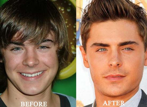 Zac-Efron-Nose-Job.jpg