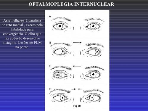 oftalmoplegia internuclear.jpg
