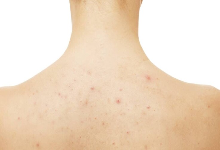 acne costas.jpg