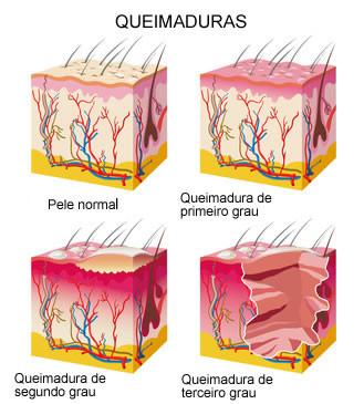 queimaduras-pele.jpg