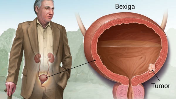 tumor da bexiga.jpg