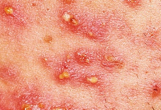 pustules.jpg