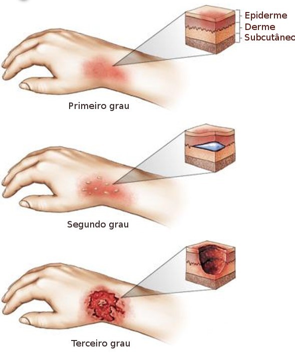 queimaduras.jpg