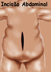 insisaoabdominal.GIF