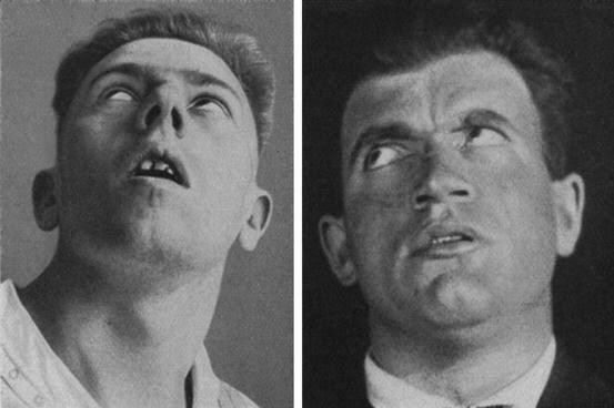 between-1915-and-1926-encephalitis-lethargica-also