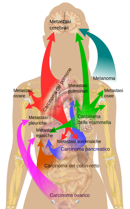 Metastasis_sites_for_common_cancers-IT.png Metastasis_sites_for_common_cancers-IT.png