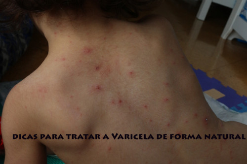 varicela last.jpg