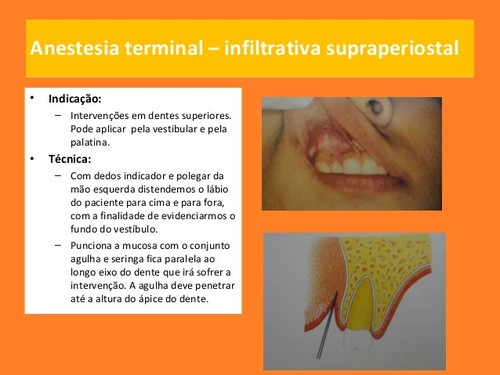 anestesia-local-em-medicina dentaria (4).jpg