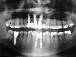 Radiografia Panorâmica da mandíbula não evidencia lesões sugestivas de