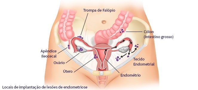 endometriose.jpg endometriose.jpg