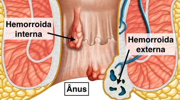 hemorróidas-externas-internas.jpg