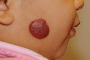 hemangioma.jpg
