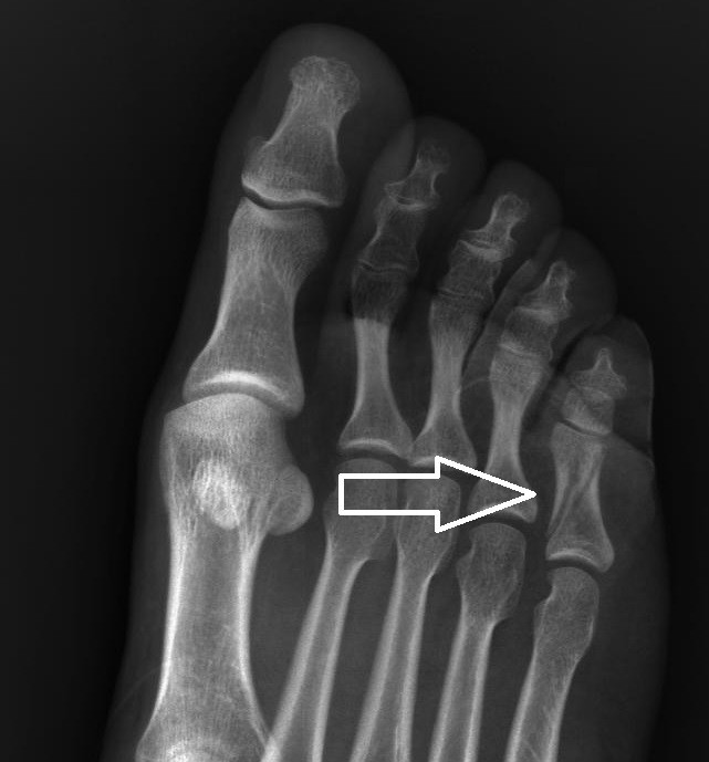 RX - pé partido - 3 semanas - diagonal.jpg