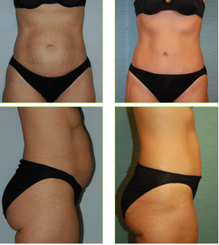 abdominoplastia-antes-e-depois.gif