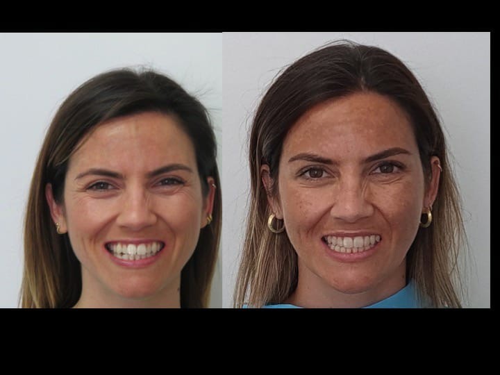antes e depois com invisalign antes e depois com invisalign