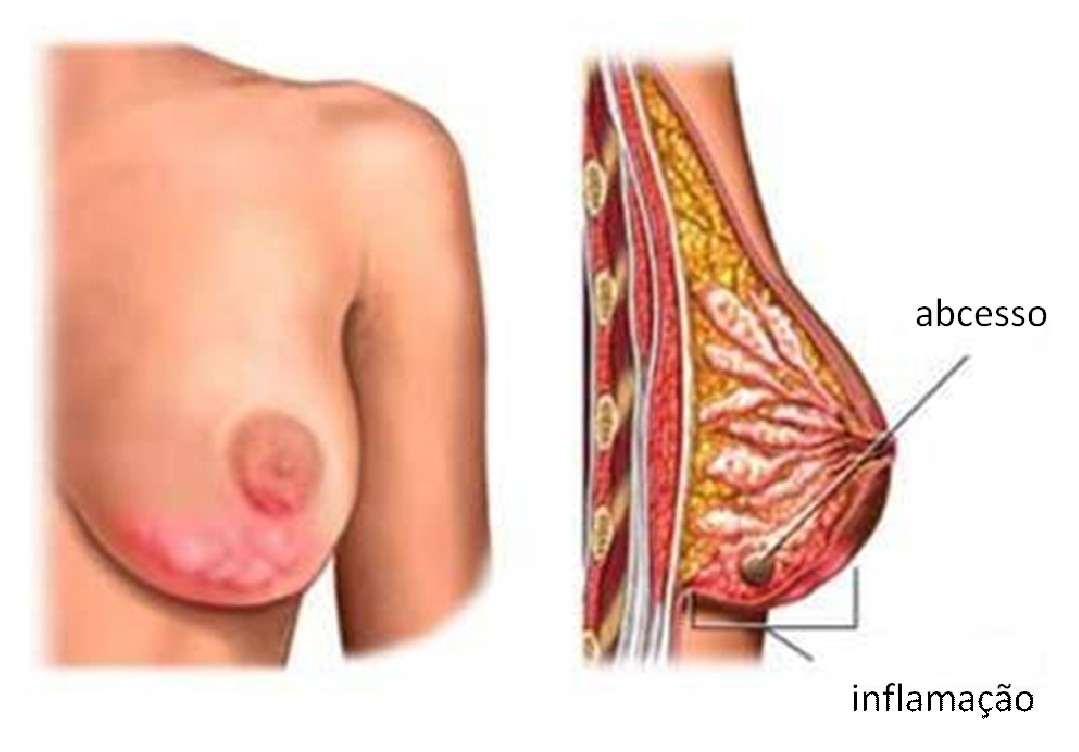 Mastite.jpg Mastite.jpg