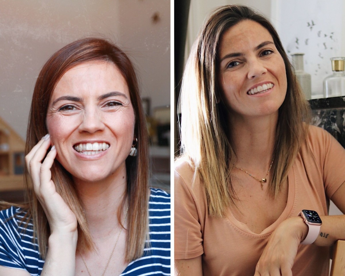 antes e depois com invisalign antes e depois com invisalign