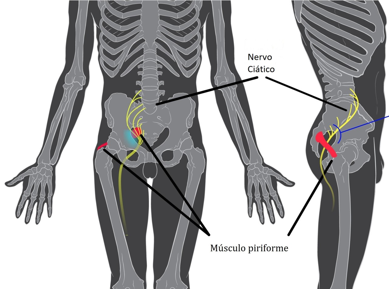 Piriformis_syndrome-es.jpg