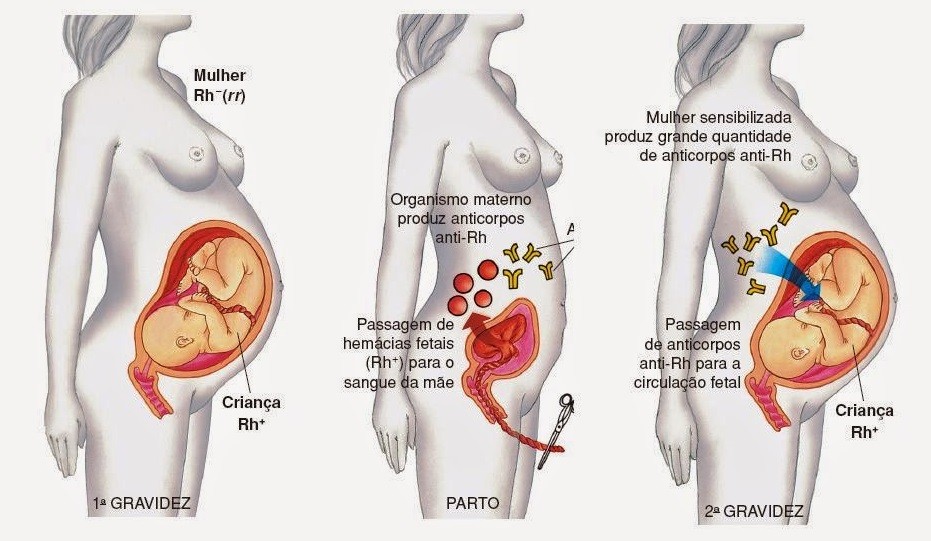 eritroblastose fetal.jpg