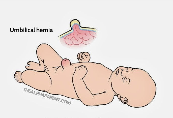 UmbilicalHernia.jpg.jpg