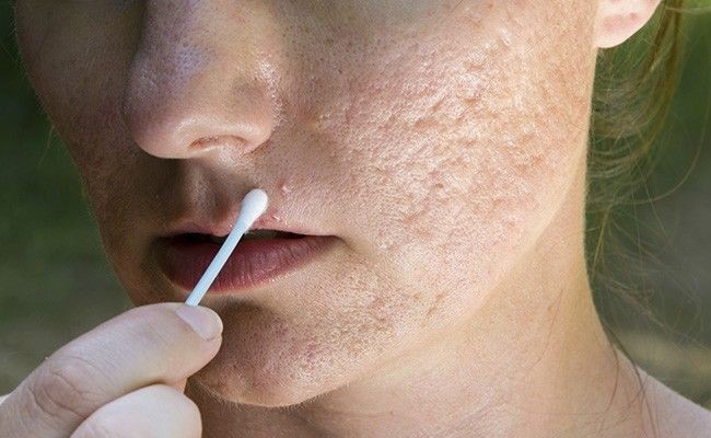 tratar-as-espinhas-do-rosto-dicas.jpg