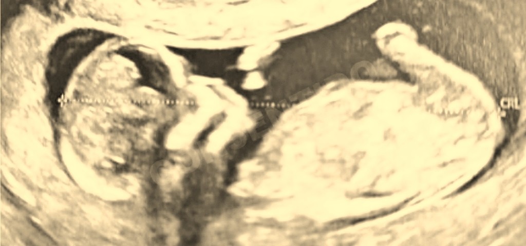 Gravidezes.jpg Gravidezes.jpg