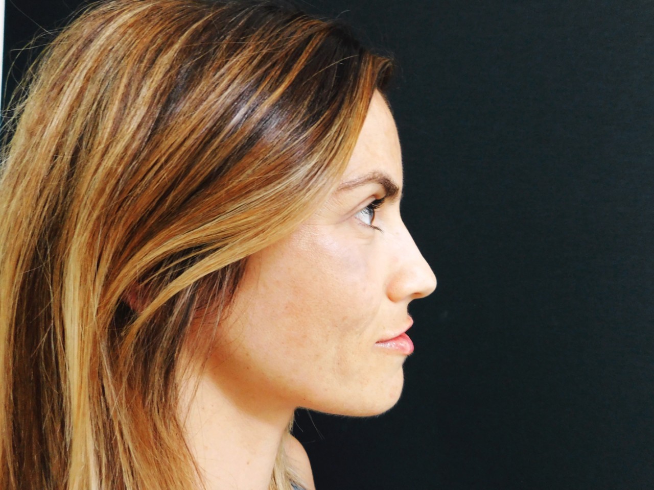 preenchimento de lábios com ácido hialurónico