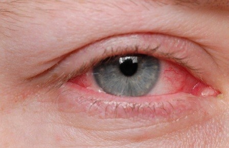 tratar-olho-irritado.jpg tratar-olho-irritado.jpg