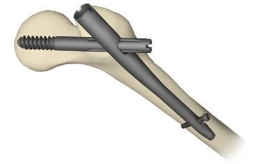 Correr 10km depois de uma perna partida.jpg