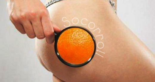 celulite-aspecto-casca-de-laranja.jpg