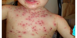 Varicela.jpg