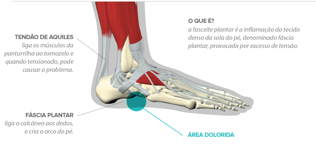 fasceite_plantar_semtitulo