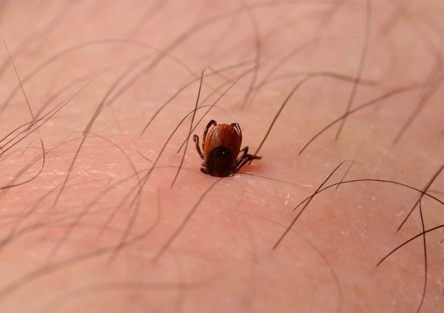 N0036758 Deer tick embedded in skin of leg.